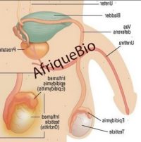 Solution Naturelle Hydrocèle Testiculaire Remède