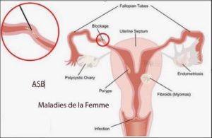 Lire la suite à propos de l’article Remède Naturel Fibrome Utérin avec l’Ail Soin Naturel