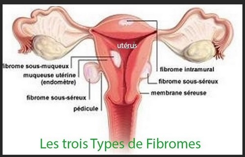 Lire la suite à propos de l’article 001-Aliments et Fibrome, Quelle alimentation en cas de Fibrome?