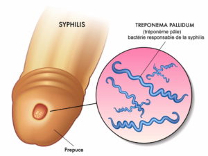 Lire la suite à propos de l’article 013-Traitement Rapide et Naturel. Comment Traiter la Syphilis avec les Plantes