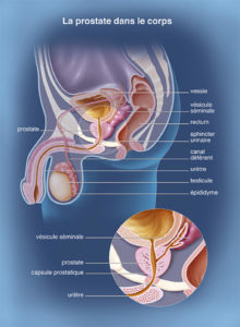 Cancer de la Prostate. Symptômes, Causes