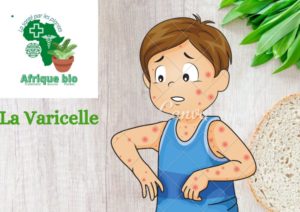 Lire la suite à propos de l’article Traiter la Varicelle  avec les Plantes. Quel est le Traitement et les symptômes?