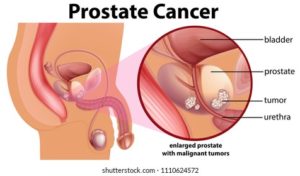 Lire la suite à propos de l’article 016-Traitement et nette guérison du Cancer de la Prostate. Explications