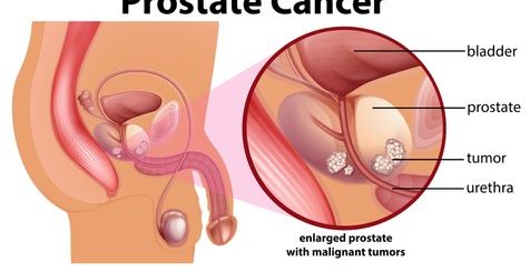 Prostatites Traitement Naturel Maladies de la Prostate : Comment Eviter ?