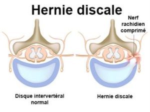 Lire la suite à propos de l’article Comment Traiter la Hernie Discale? Solutions Naturels et simple