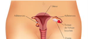 Lire la suite à propos de l’article Débloquer Résoudre L’infertilité et Tomber Enceinte Trompes Bouchées Quelle Solution