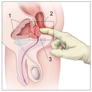 Prostatite toucher-rectal