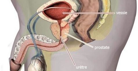 Comment Eviter la Prostate ? Prostatite Traitement Naturel Par les Plantes. Voici ce qu'il vous faut comme remède.