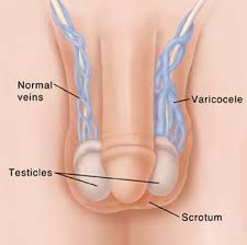 Lire la suite à propos de l’article Varicocèles Solution Naturelle Sans La Chirurgie : Remède Par les Plantes