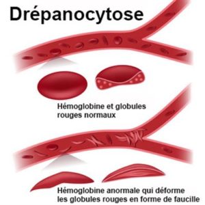 Lire la suite à propos de l’article Drépanocytose Traitement Naturel Soigner la Drépanocytose