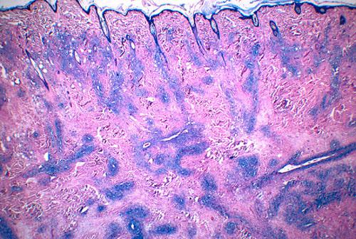 Lire la suite à propos de l’article Histiocytofibromes : Causes et Méthodes de Traitement pour Soigner