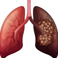 Remède 401 : Chance de Guérison Cancer du Poumon Soin Naturel