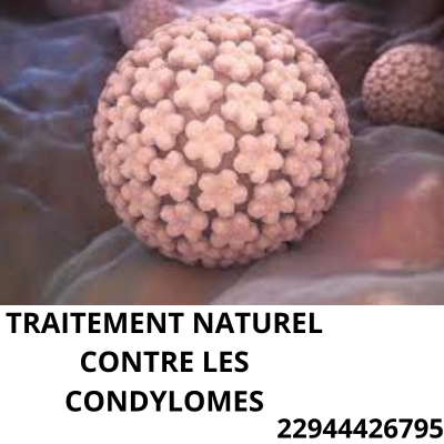 Lire la suite à propos de l’article Causes des condylomes : Traitement naturel contre les condylomes